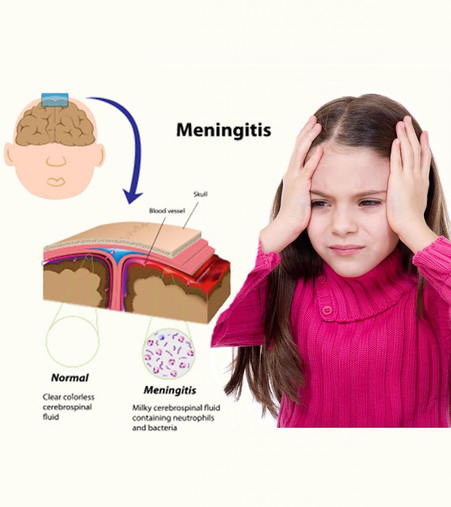 Meningitis In Children Causes Symptoms And Treatment