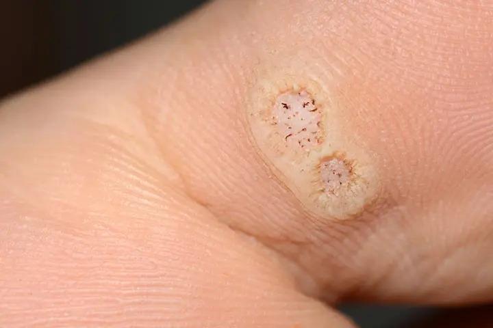 Plantar warts in babies