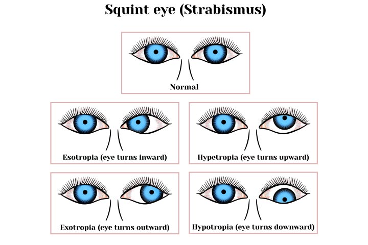 Types of strabismus or crossed eyes In infants