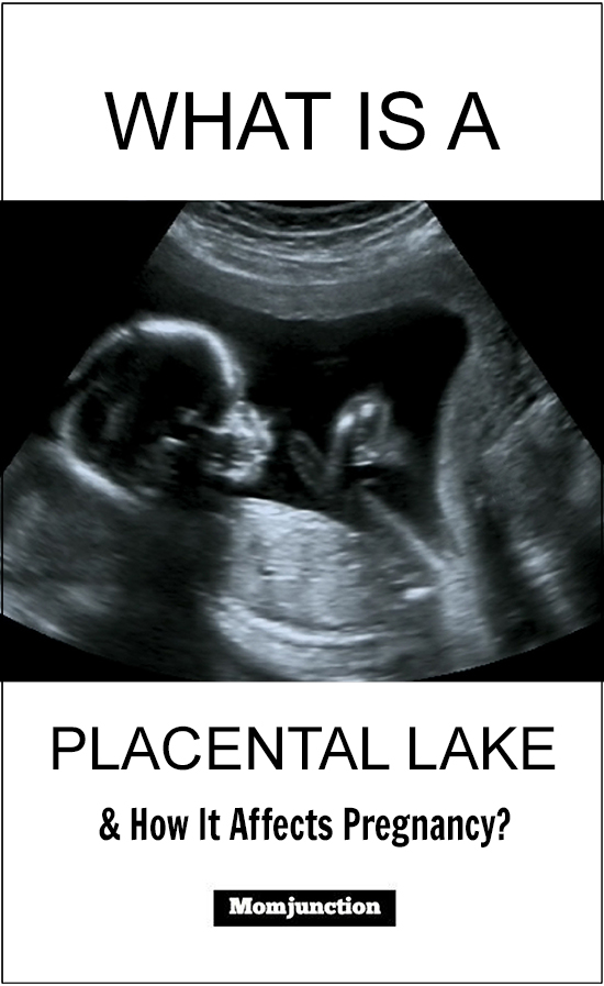 What is A Placental Lake And How It Affects Pregnancy