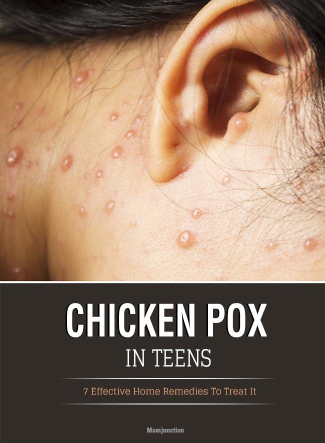 7 Effective Home Remedies To Treat Chicken Pox in Teens