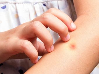 7 Remedies To Treat Mosquito Bites In Children