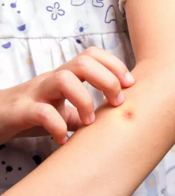 7 Remedies To Treat Mosquito Bites In Children