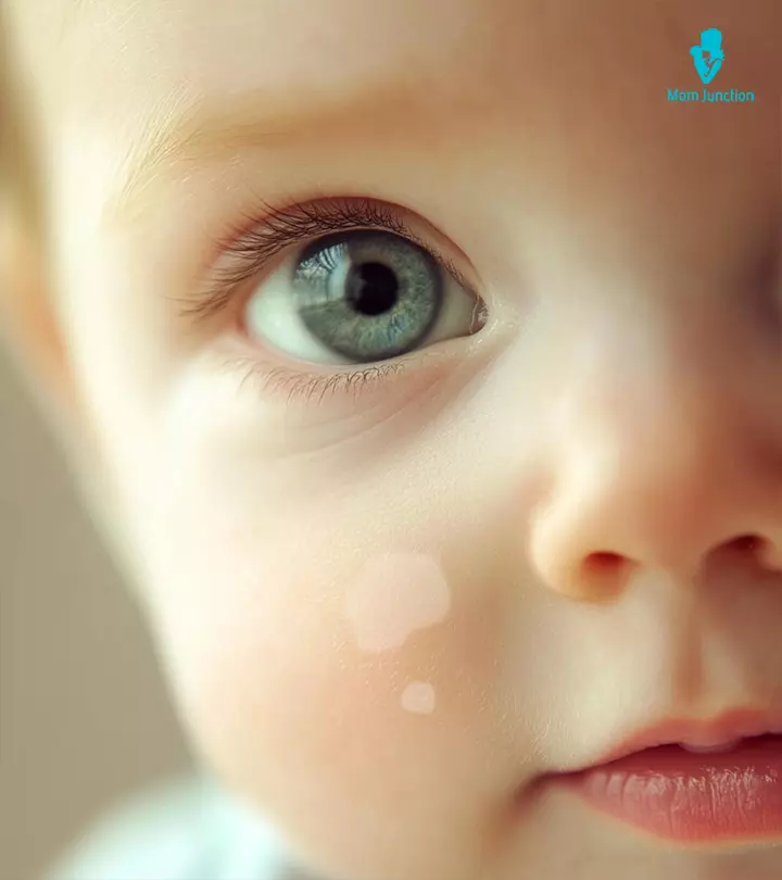 Baby With Vitiligo Spots