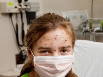 Symptoms Of Chickenpox In Children, Its Causes & Remedies