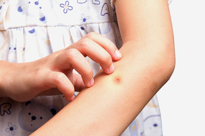 7 Remedies To Treat And Prevent Mosquito Bites On Kids