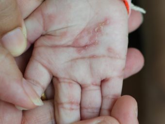 Scabies In Babies: Causes, Risks, Treatment And Remedies