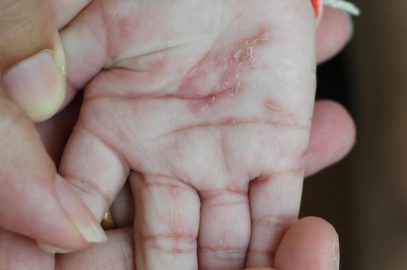 Scabies In Babies: Causes, Risks, Treatment And Remedies