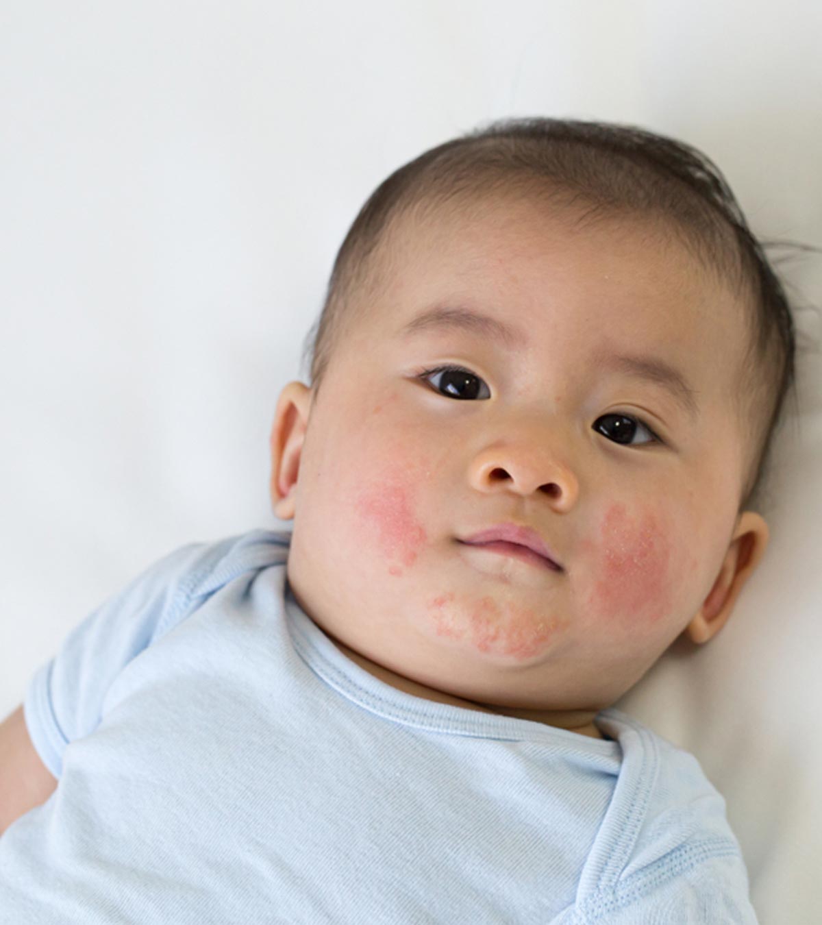 Toddler Acne: Causes, Symptoms And Treatment