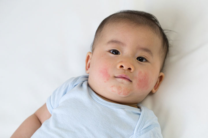 5 Causes Of Acne In Toddlers And How To Treat It