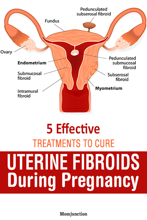 5 Best Treatments For Uterine Fibroids During Pregnancy 