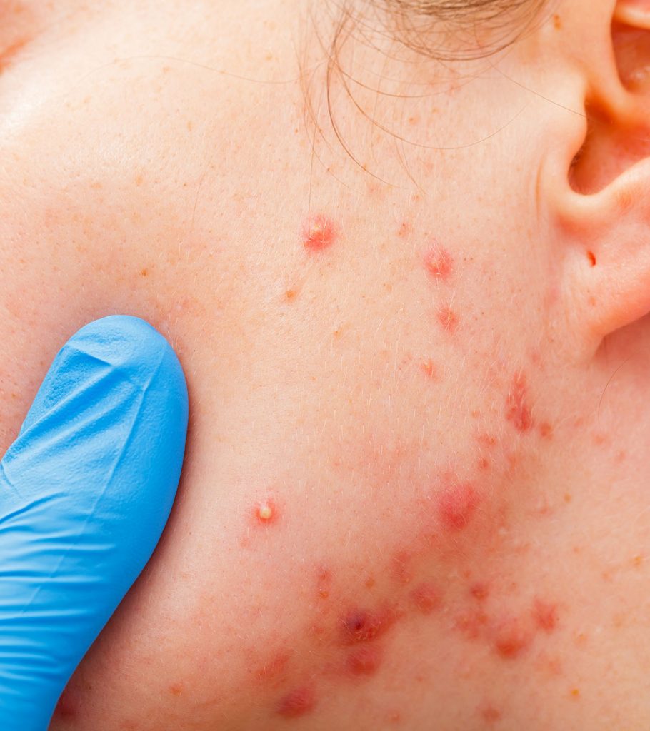Acne In Children Causes, Symptoms And Treatment