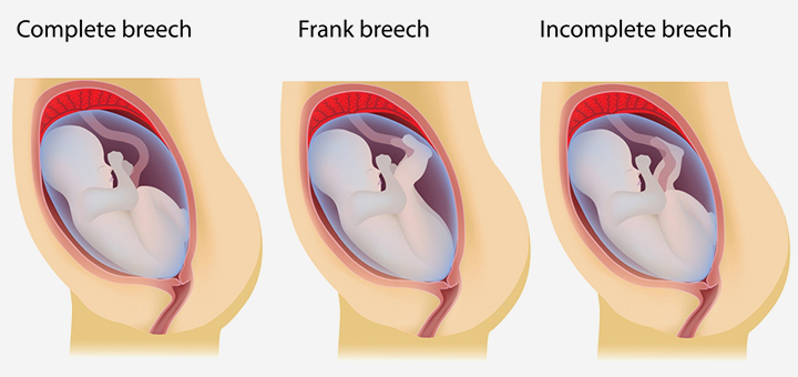 Breech position, 40th week pregnancy