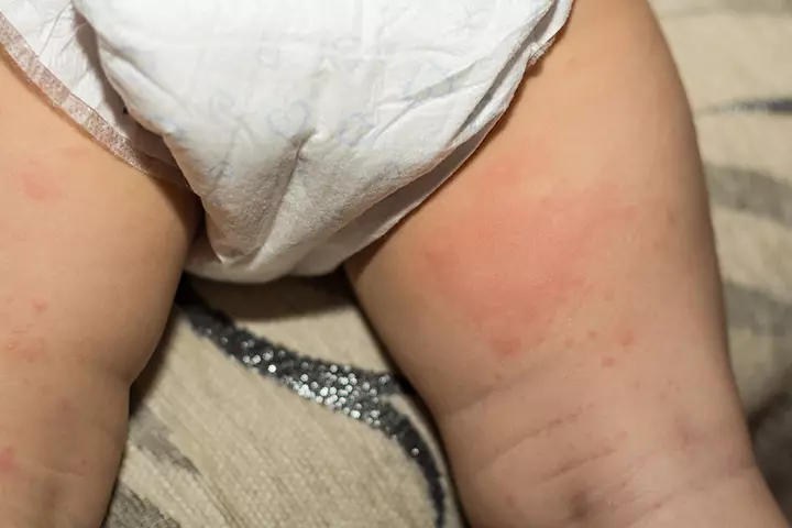 Candida diaper rash fungal infection in babies