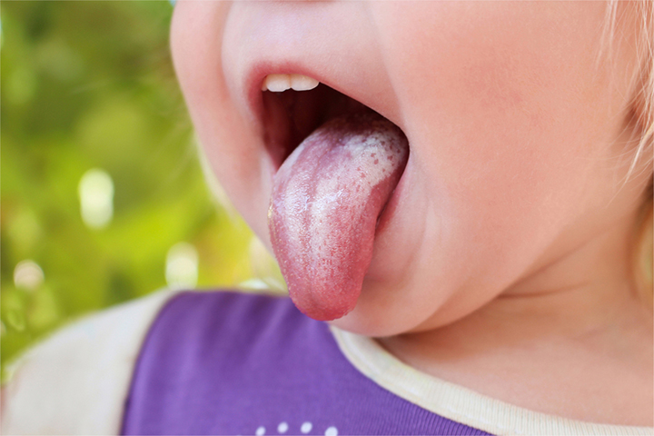 Coated tongue is a symptom of typhoid in babies and toddlers 