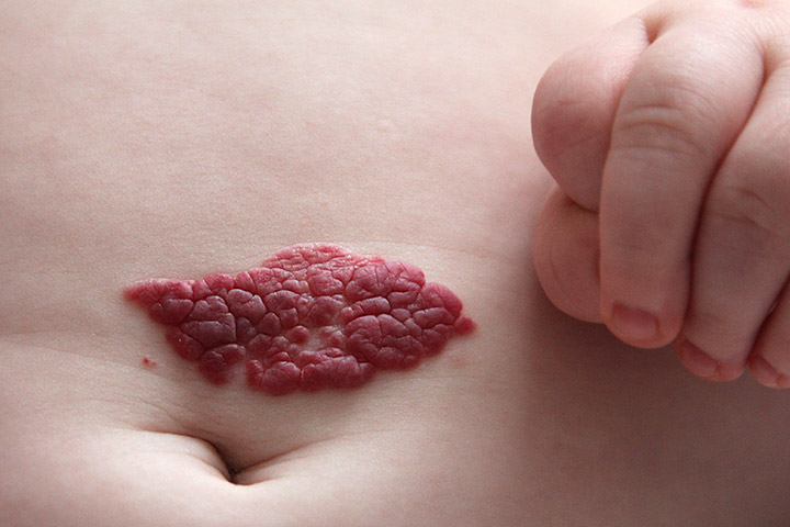 Hemangioma birthmarks in babies