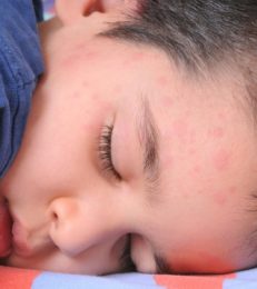 What Are Hives In Children: Causes, Symptoms And Treatment
