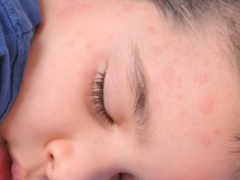 What Are Hives In Children: Causes, Symptoms And Treatment