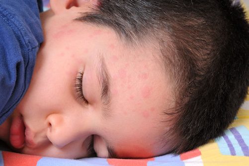 Hives In Children - Causes, Symptoms, And Natural Remedies