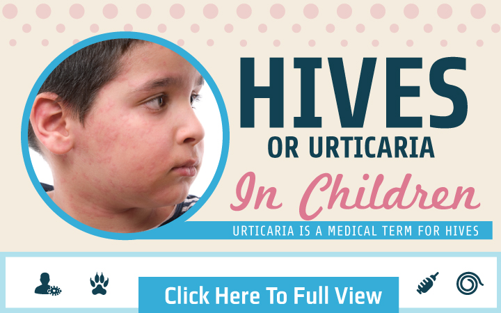 Hives-Or-Urticaria-In-Children-Thamb