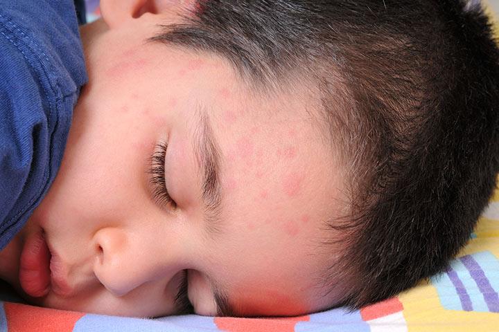 Hives In Children Causes Symptoms And Natural Remedies