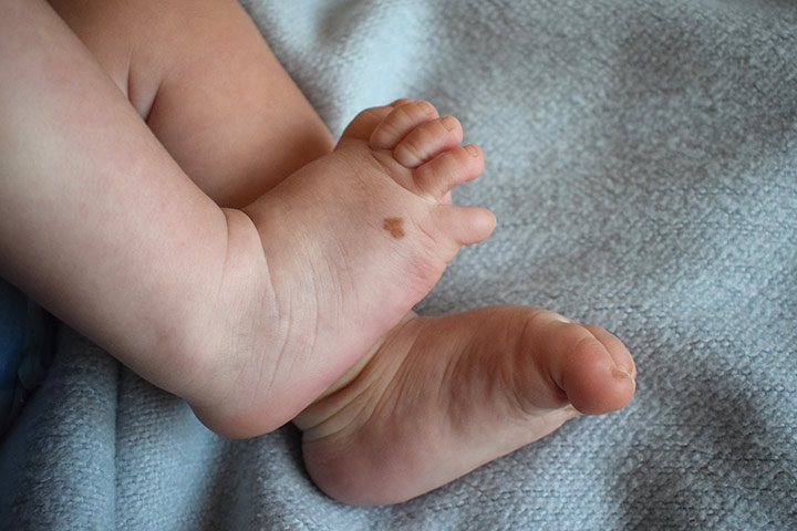 Moles birthmarks in babies