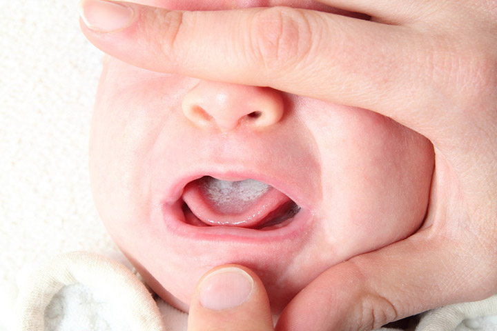 Oropharyngeal candidiasis or thrush fungal infection in babies