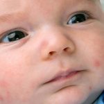 Petechiae In Babies – Causes, Diagnosis & Treatments You Should Be Aware Of