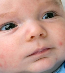 Petechiae On Baby: Causes, Symptoms, Diagnosis And Treatment