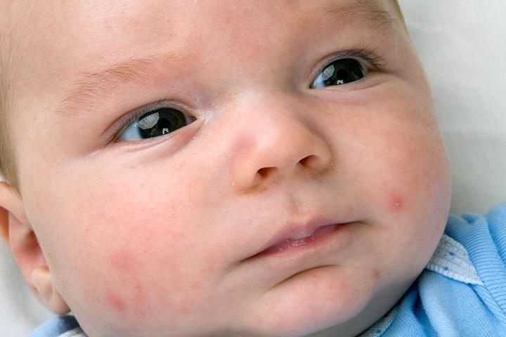 Petechiae In Babies Causes Signs Diagnosis And Treatment