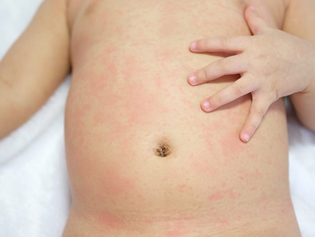 roseola-in-toddlers-causes-symptoms-and-treatment