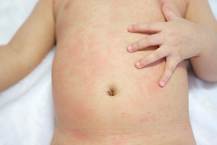 Do Babies Get Fever Rash