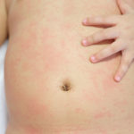 Roseola In Toddlers