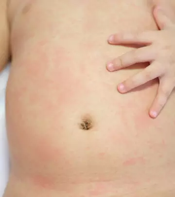 Roseola In Toddlers