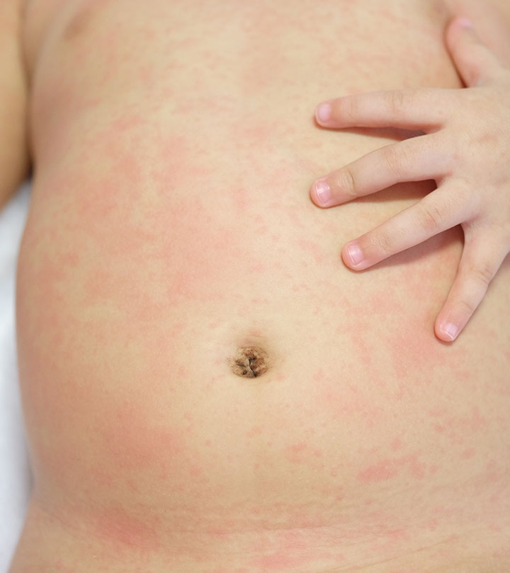 Causes Of Roseola In Toddlers, Signs, Treatment & Prevention