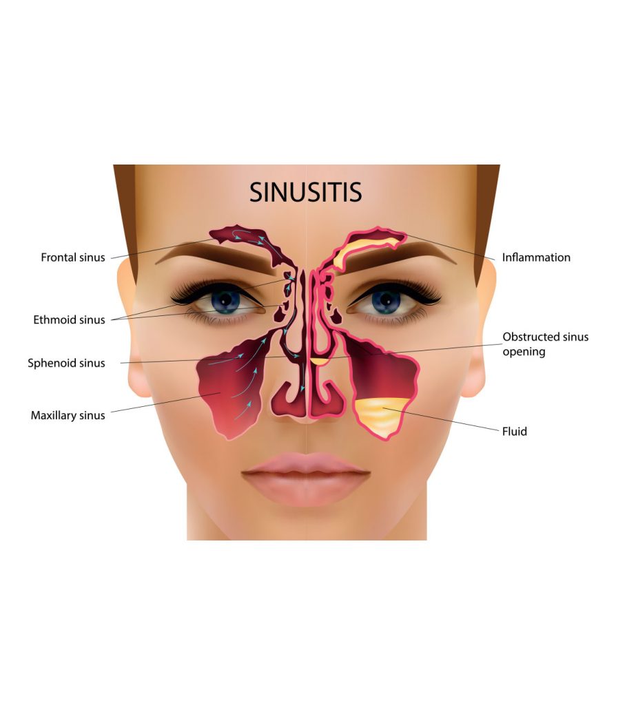baby sinus infection smell