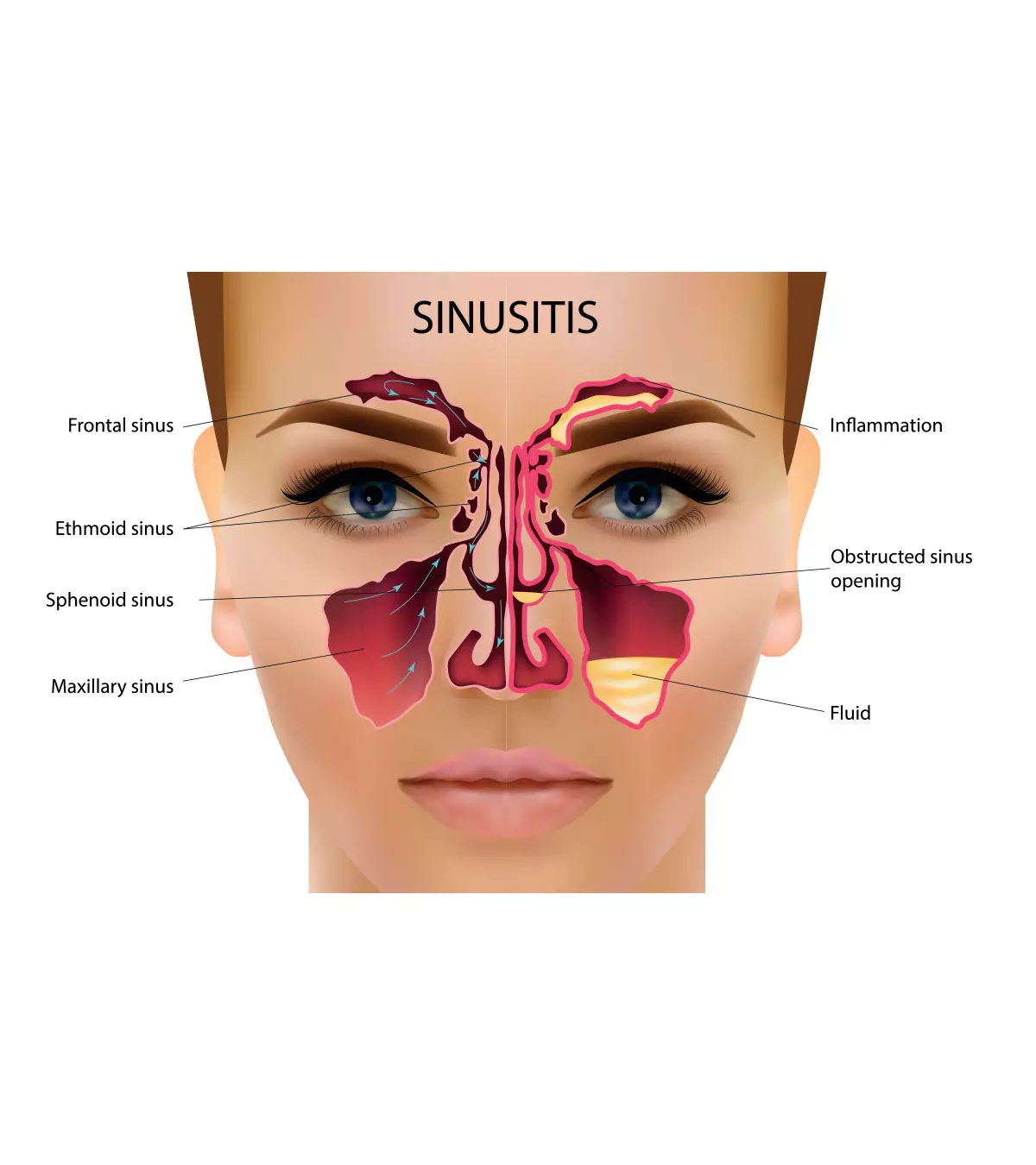 Sinus Infection When Breastfeeding: Treatment And Home Remedies