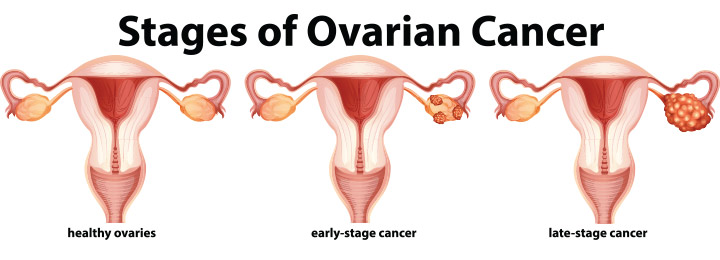 Stages of ovarian cancer in teens