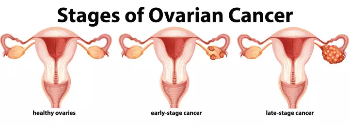Стадии рака яичников у подростков