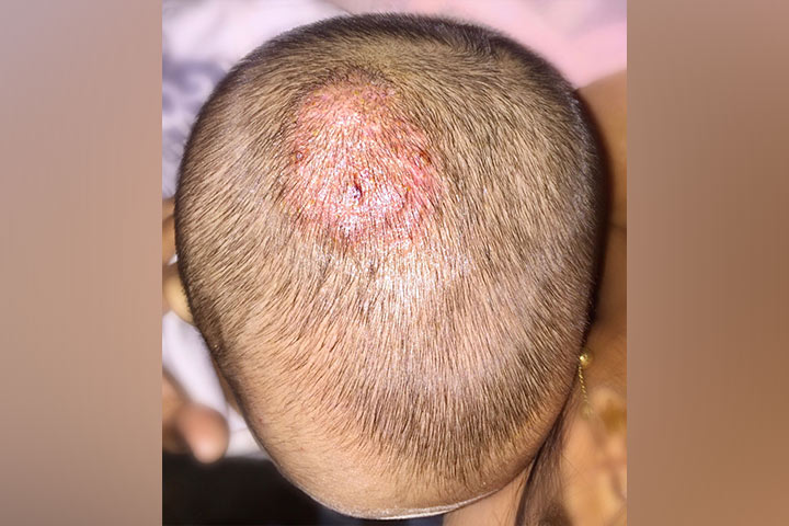 Tinea or ringworm fungal infection in babies
