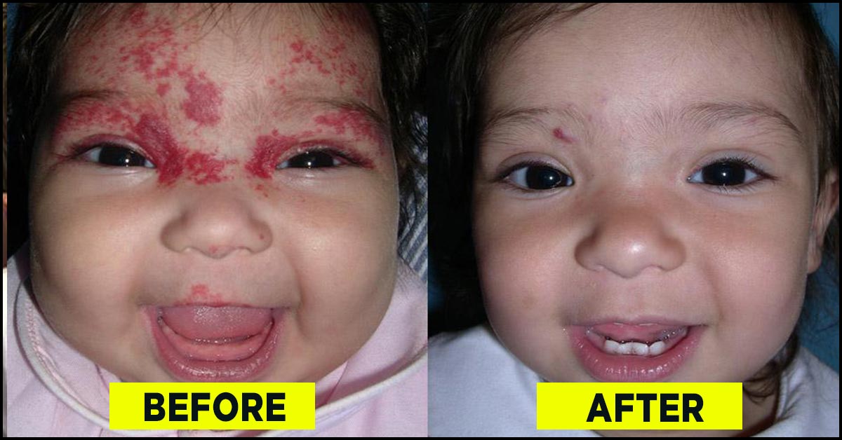 What Causes Birthmarks In Babies And How To Remove Them