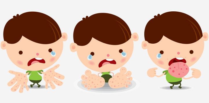 Coxsackievirus In Children - How Serious Is It?