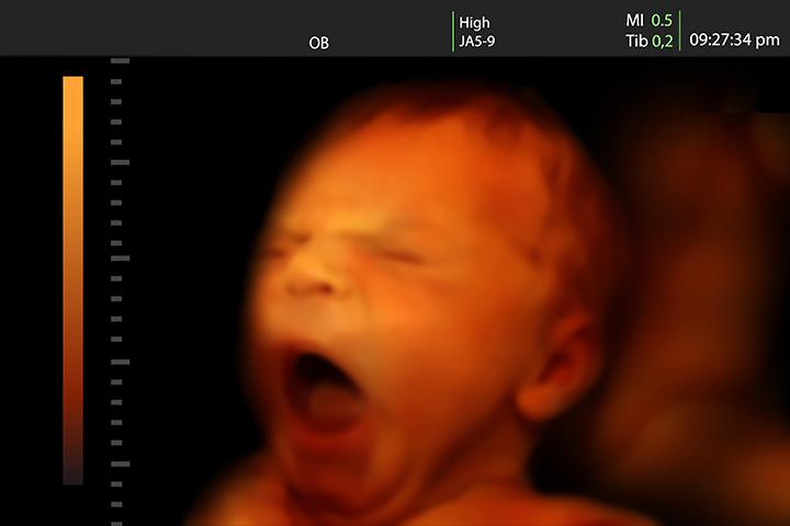 3D Ultrasound - When To Do & Is It Safe?