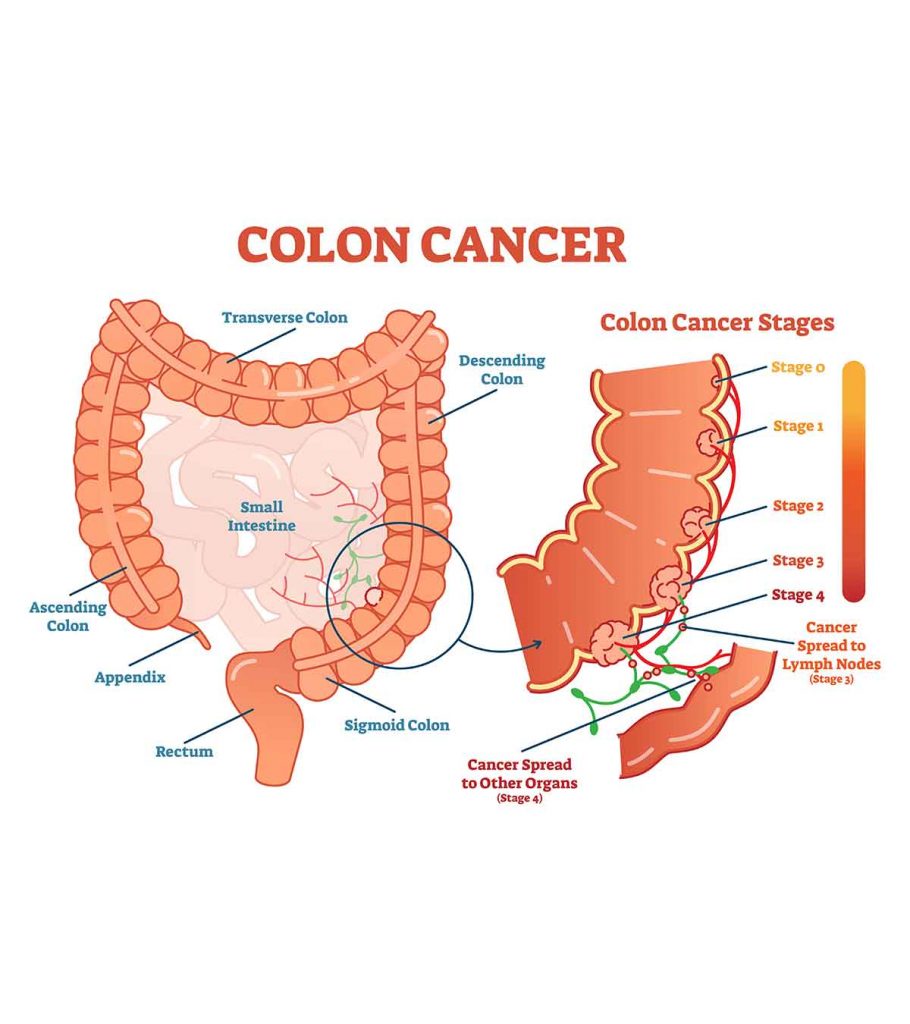 cancer colon transverse symptoms)