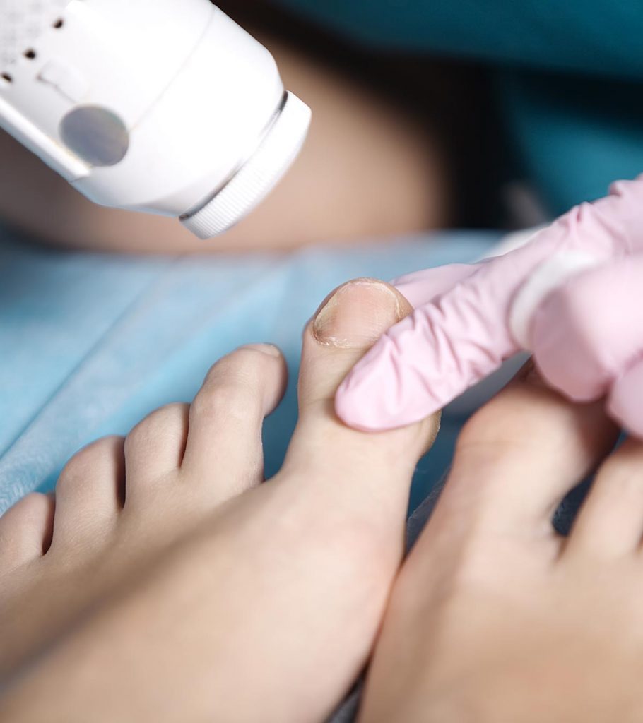 7-serious-symptoms-of-fungal-nail-infection-in-children