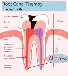 Abscess Tooth While Pregnant - Causes, Symptoms & Preventions You Should Be Aware Of