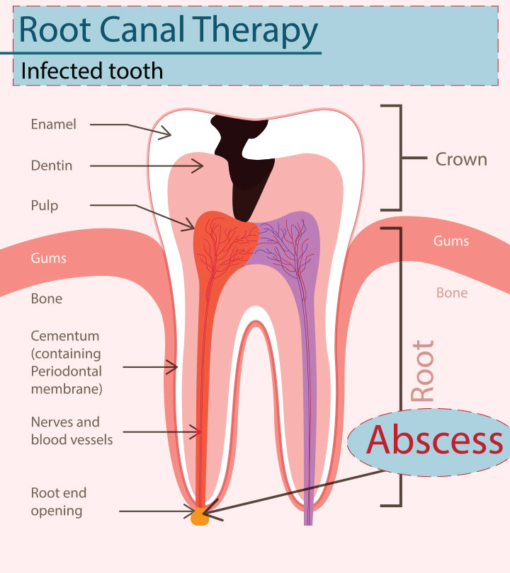 Abscess Tooth While Pregnant - Causes, Symptoms & Preventions You Should Be Aware Of