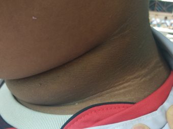 Acanthosis Nigricans In Kids: Signs, Causes, Pictures & Treatment