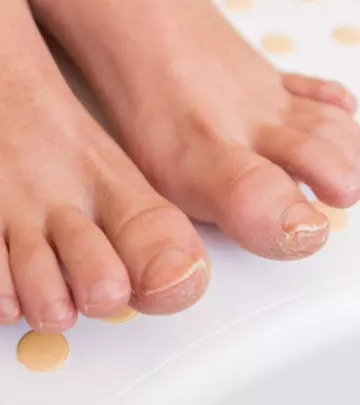 Fungal Nail Infection In Children Symptoms, Remedies And Treatment,