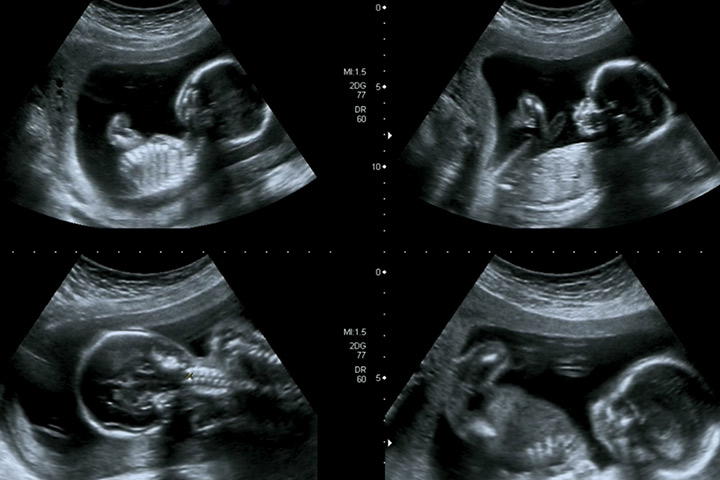 Ultrasound scan image when third month pregnant